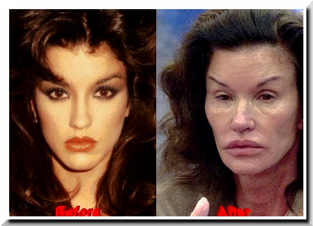 Janice Dickinson Before After
